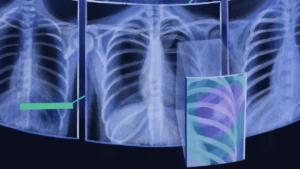 人工智能助力X射线诊断